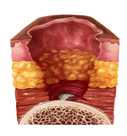 Stage 4 Injury